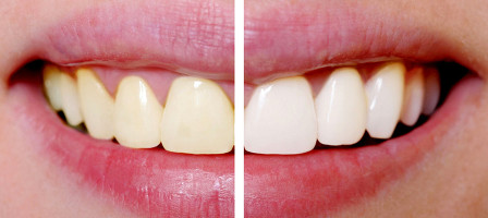 Can professional teeth whitening damage your teeth