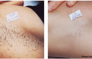 Laser Hair Removal Butler Pa Mondani Marsha Electrolysis Laser