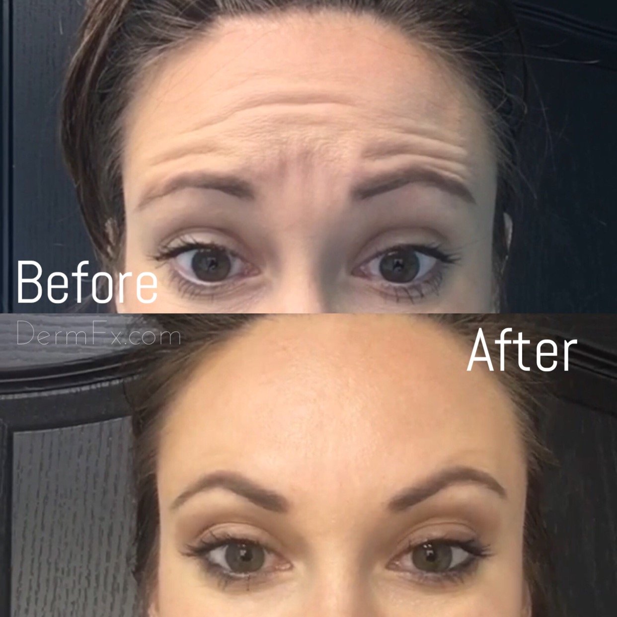 Dysport | Injectable Skin Treatments | Sunset Beach, CA