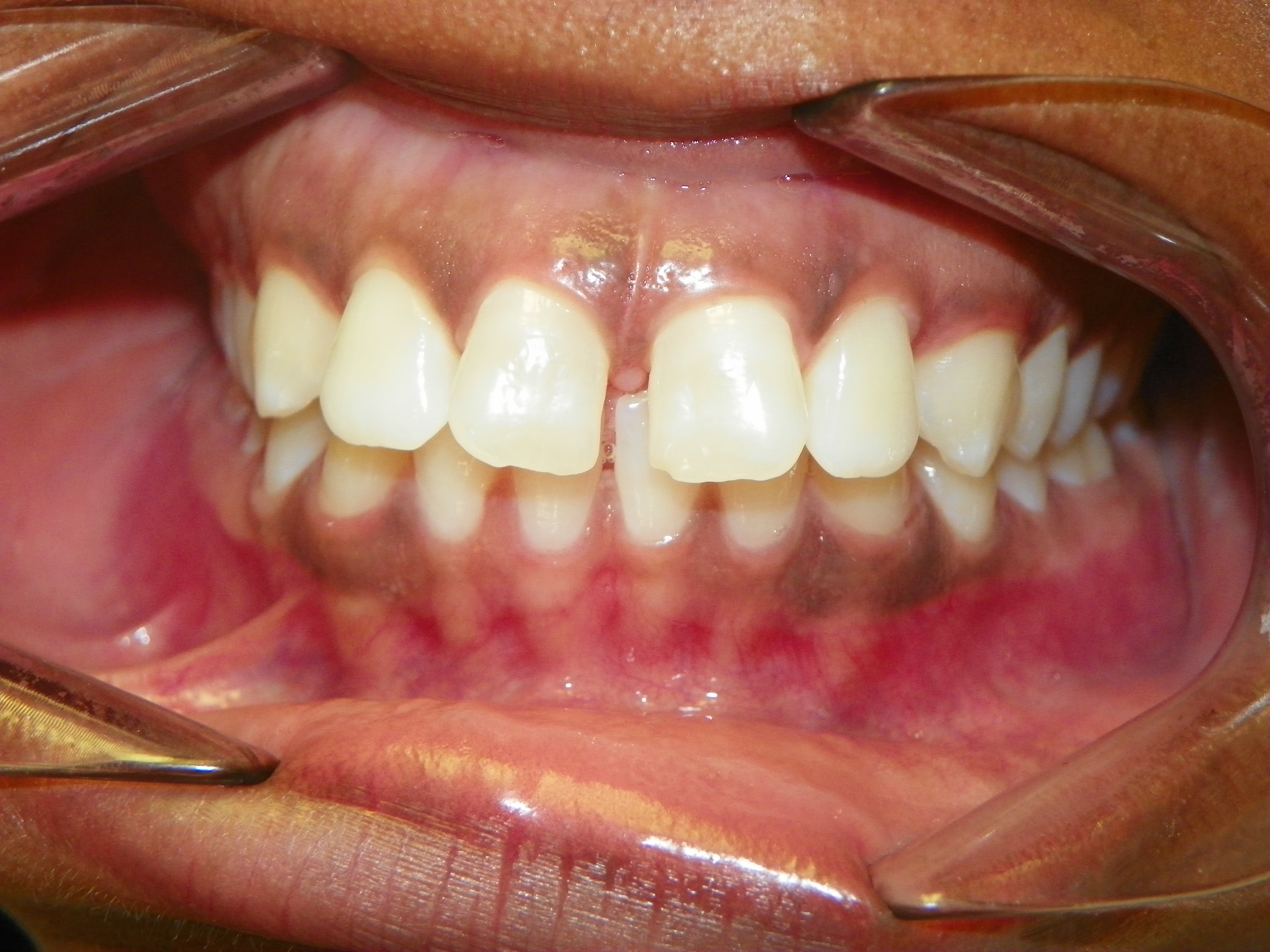 Orthodontic Care Straighten Teeth Jackson, MS