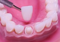 Churchville, PA - Porcelain Dental Crowns-Partial & Complete Crowns in Churchville, PA