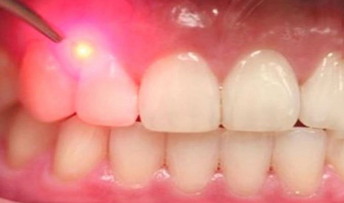 laser periodontal surgery lanap treatment toledo oh periodontal surgery