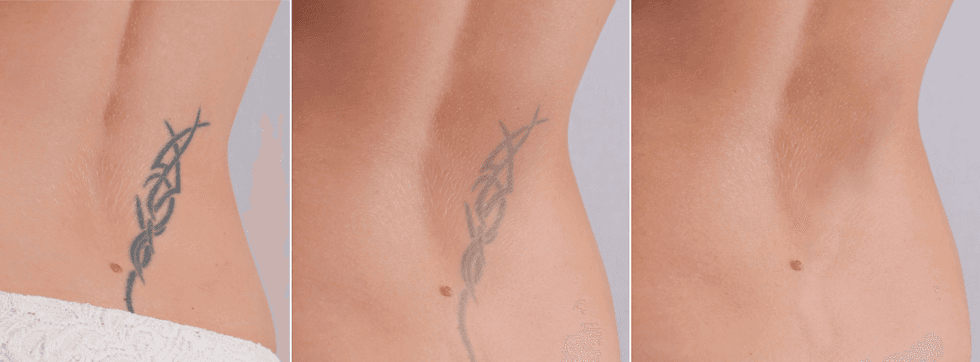 tattoo removal tattoos elimination plymouth ma tattoo removal tattoos elimination plymouth ma
