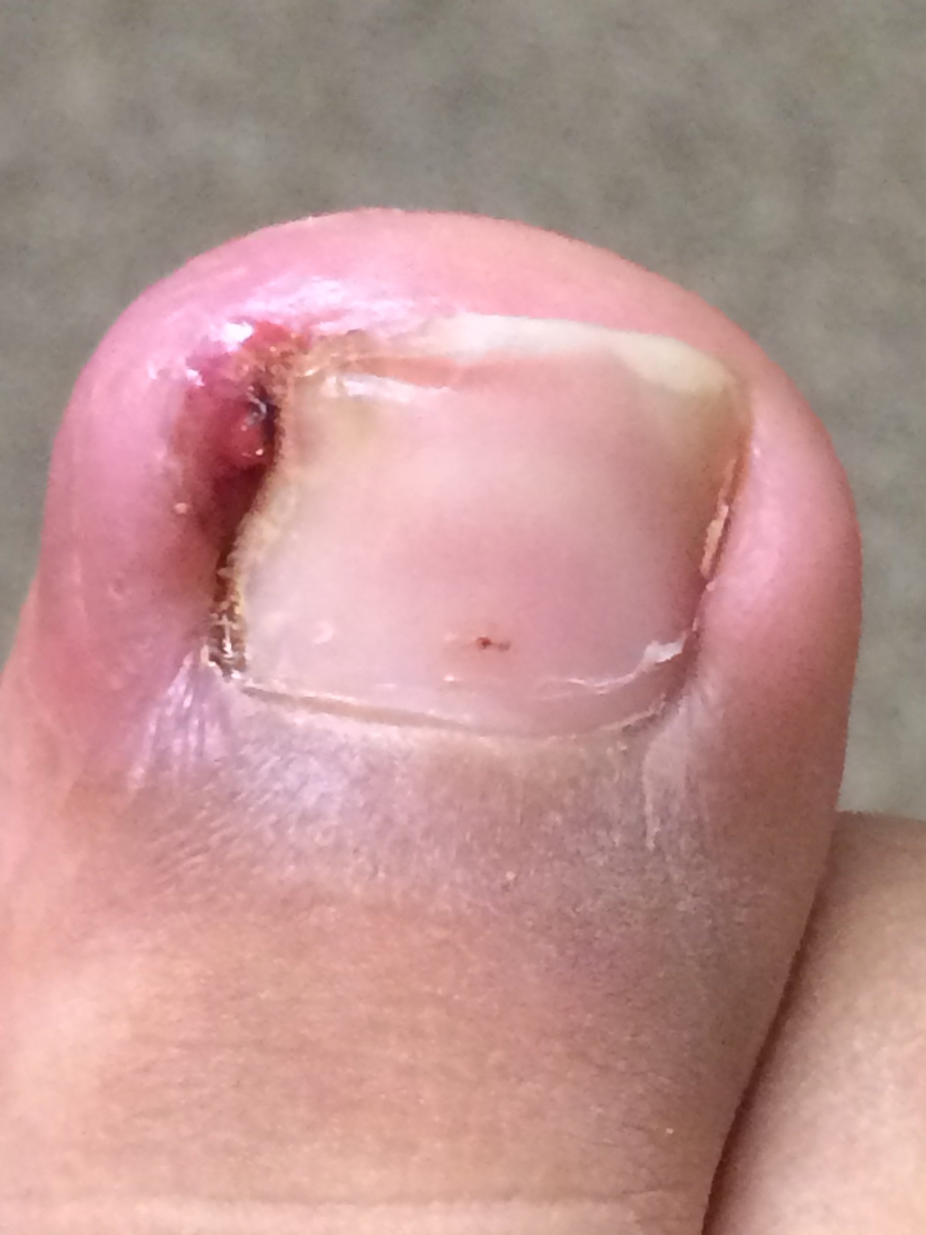 Ingrown nails Bowling Green, KY