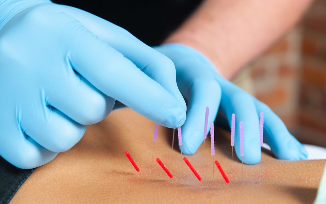 Central Effects of Dry Needling