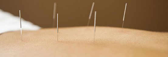 Body acupuncture